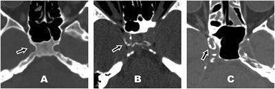 Vitamin K Antagonist Use and Risk for Intracranial Carotid Artery Calcification in Patients With Intracerebral Hemorrhage